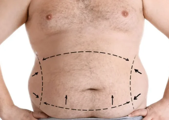 Estética Pós-Bariátrica: Entenda os Desafios e Soluções da Cirurgia Reconstrutora